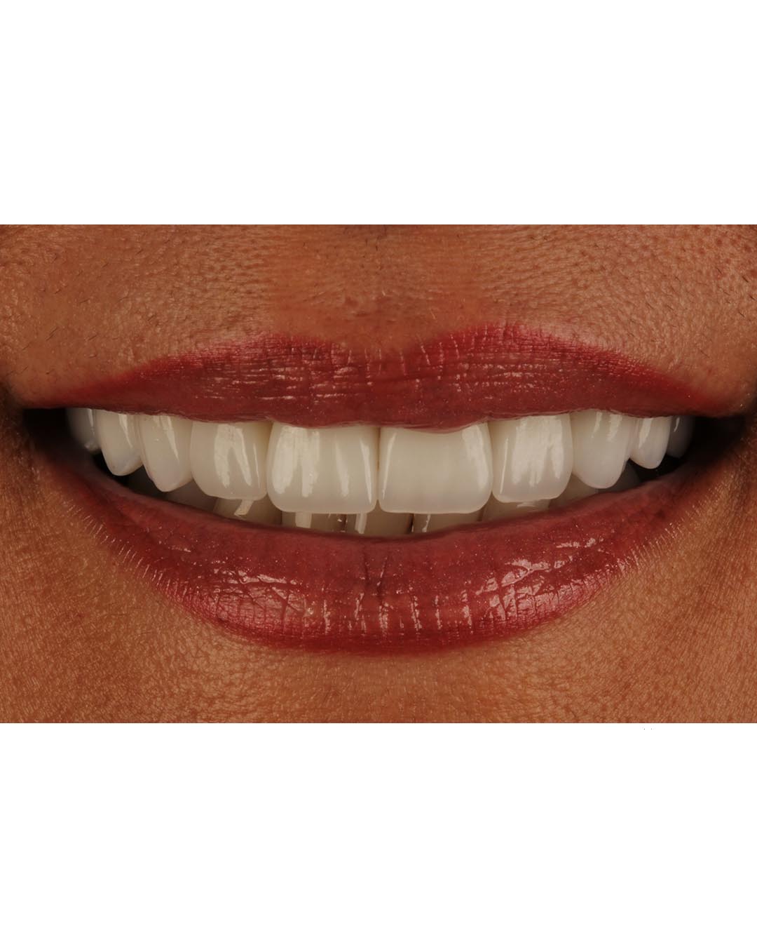 Veneers are a simpler dental solution for a beautiful smile while being simpler than implants and crowns