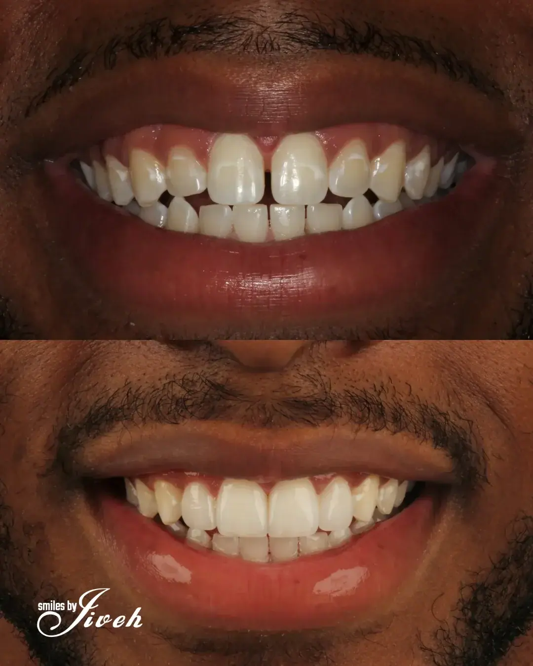 Before and after smile transformation by Smiles By Jiveh