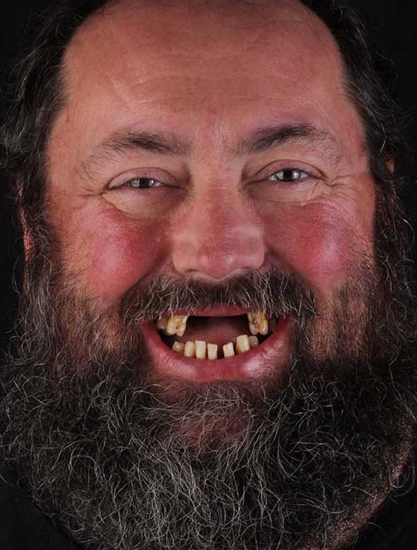 Before dental implants with missing front teeth.