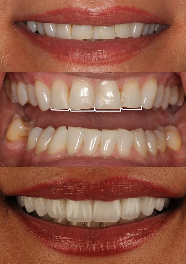 Dental veneers in upper and lower front teeth.