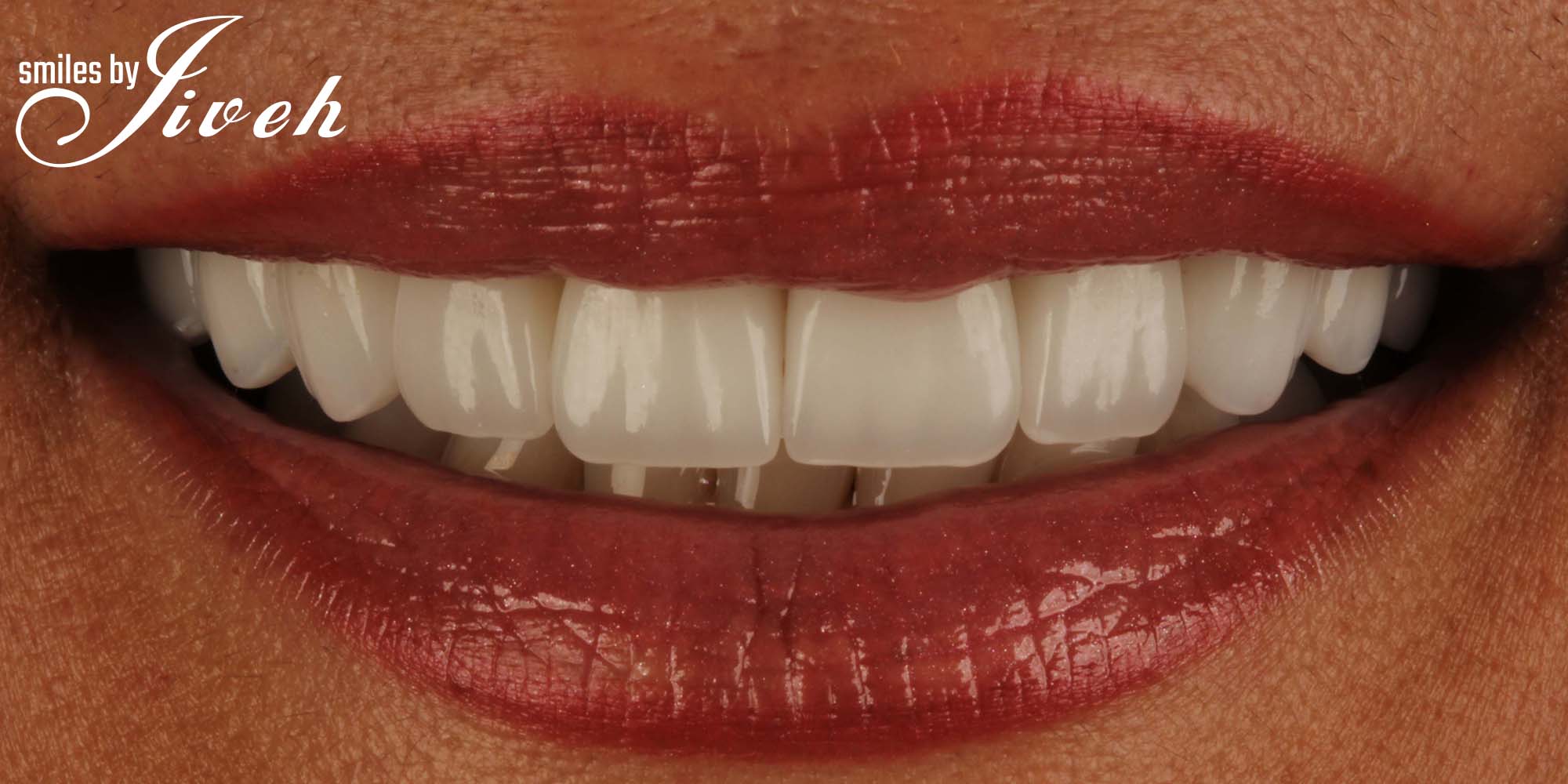 Dentist an dental clinic in Royal Palm Beach and Wellington offering general and cosmetic dentistry including implants, crowns, bridges and full mouth reconstructive dentistry.