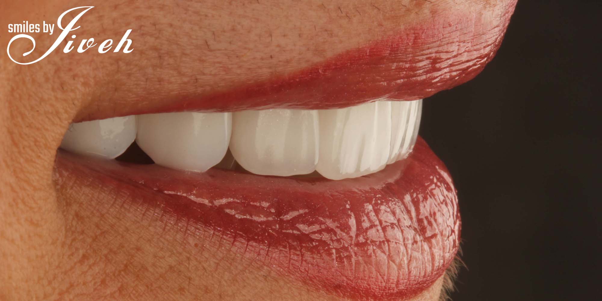 Veneers are a simpler dental solution for a beautiful smile while being simpler than implants and crowns.