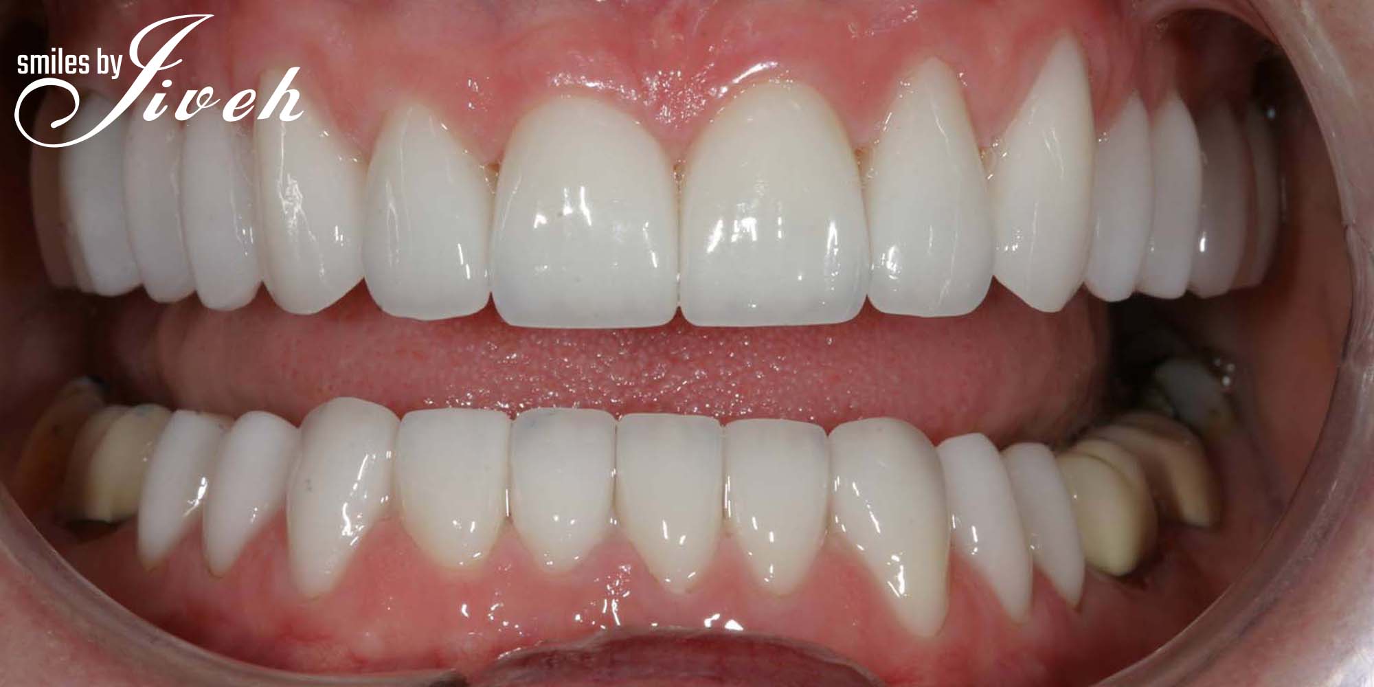 If you need a solution for your teeth and mouth in Wellington or Royal Palm Beach, we can make your smile perfect and your mouth healthy, from veneerds and crwons to implants and a full dental reconstruction.